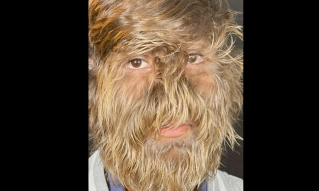 മുഖത്ത് ഏറ്റവും അധികം രോമവുമായി ഗിന്നസില്‍ ഇടം നേടിയ ലളിത് പട്ടീദാര്‍ ഇനി ലോകം അറിയപ്പെടും, കുട്ടിക്കാലത്തെ ഓര്‍മകള്‍ പങ്കുവെച്ച് ലളിത്