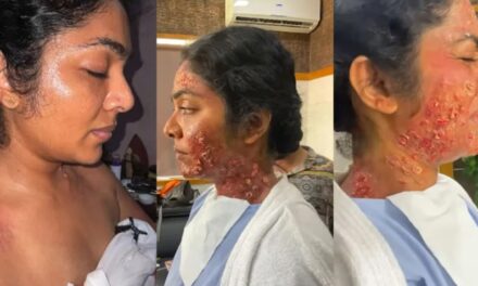 റിമ കല്ലിങ്കലിന്റെ ശരീരത്തിൽ പ്രാണി കടിച്ചതിനു ശേഷം ത്വക്കിനുണ്ടാകുന്ന മാറ്റങ്ങൾ ; പ്രോസ്തറ്റിക് മേക്കപ്പ് വീഡിയോ പങ്കുവെച്ച് സേതു ശിവാനന്ദൻ