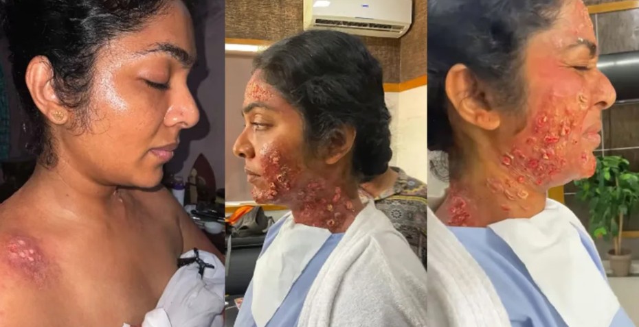 റിമ കല്ലിങ്കലിന്റെ ശരീരത്തിൽ പ്രാണി കടിച്ചതിനു ശേഷം ത്വക്കിനുണ്ടാകുന്ന മാറ്റങ്ങൾ ; പ്രോസ്തറ്റിക് മേക്കപ്പ് വീഡിയോ പങ്കുവെച്ച് സേതു ശിവാനന്ദൻ