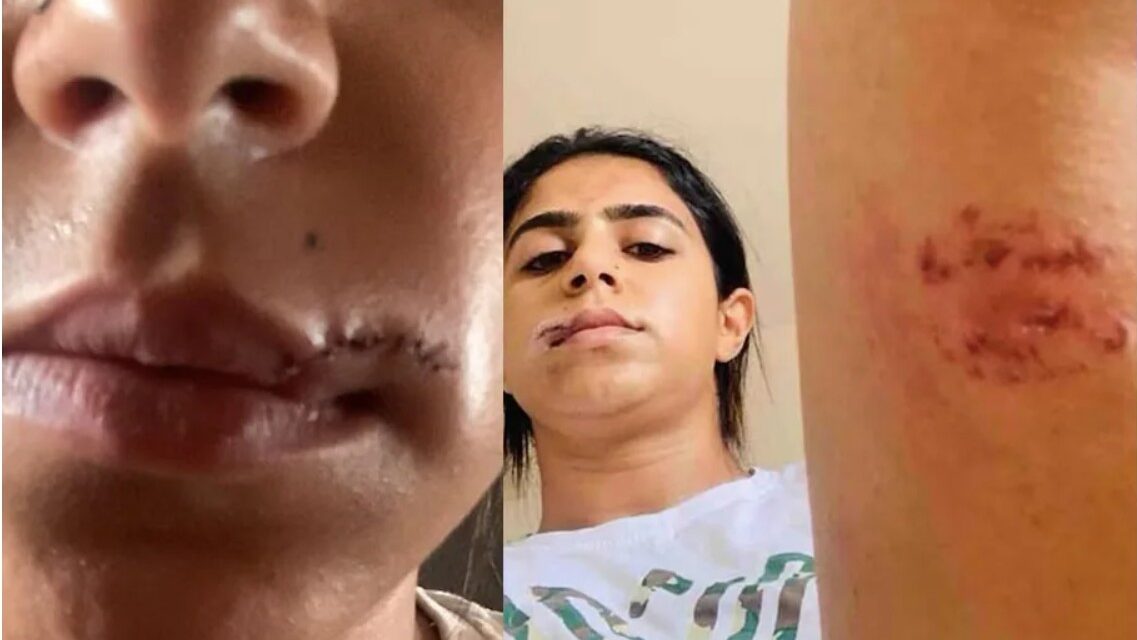 വയറ്റിൽ ചവിട്ടി, മുഖത്ത് ഇടിച്ചു, മേല്‍ച്ചുണ്ട് മുറിഞ്ഞുപോയി, തുടയില്‍ കടിച്ചു, തല പിടിച്ച് പല പ്രാവശ്യം തറയിലിടിച്ചു..!! മുൻ പങ്കാളിയുടെ പീഡനങ്ങൾ വെളിപ്പെടുത്തി നടി ജസീല :  ഞെട്ടിപ്പിക്കുന്ന ചിത്രങ്ങൾ