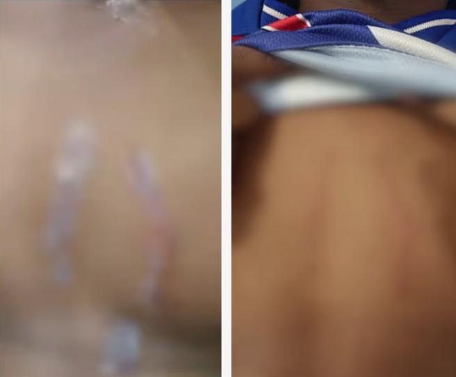 മറ്റൊരു മുറിയില്‍ പോയി കിടക്ക് : കാമുകിയോടൊപ്പം കിടക്കാൻ കുട്ടി സമ്മതിക്കുന്നില്ല ,കലികയറിയ കാമുകൻ 12 വയസുകാരനെ ക്രൂരമായി മർദിച്ചു : തല ഭിത്തിയിലിടിപ്പിച്ചു, നെഞ്ചിൽ മാന്തി: അമ്മയും ആൺസുഹൃത്തും പിടിയിൽ