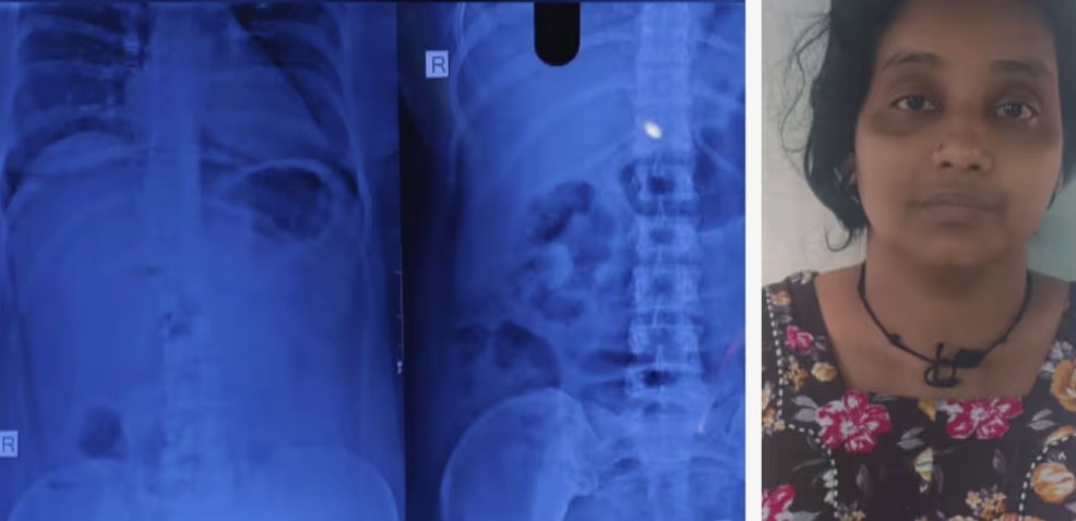 ക്ലിനിക്കിലെത്തിയ കുട്ടിയു‌ടെ അടുത്തിരുന്ന് താലോലിച്ച് തക്കം നോക്കി സ്വർണമാല മോഷ്ടിച്ചു, രക്ഷിതാക്കൾ പരിശോധിക്കാൻ ഒരുങ്ങിയപ്പോൾ മാല വിഴുങ്ങി, യുവതി അറസ്റ്റിൽ, എനിമ നൽകിയെങ്കിലും ആഭരണം പുറത്തുവന്നില്ല; യുവതിക്ക് കാവലിരുന്ന് പൊലീസ്